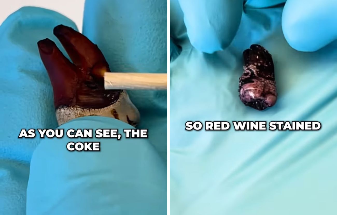 A sinistra gli effetti della Cola e a destra quelli del vino rosso, ufficialmente la bevanda che macchia di più i denti