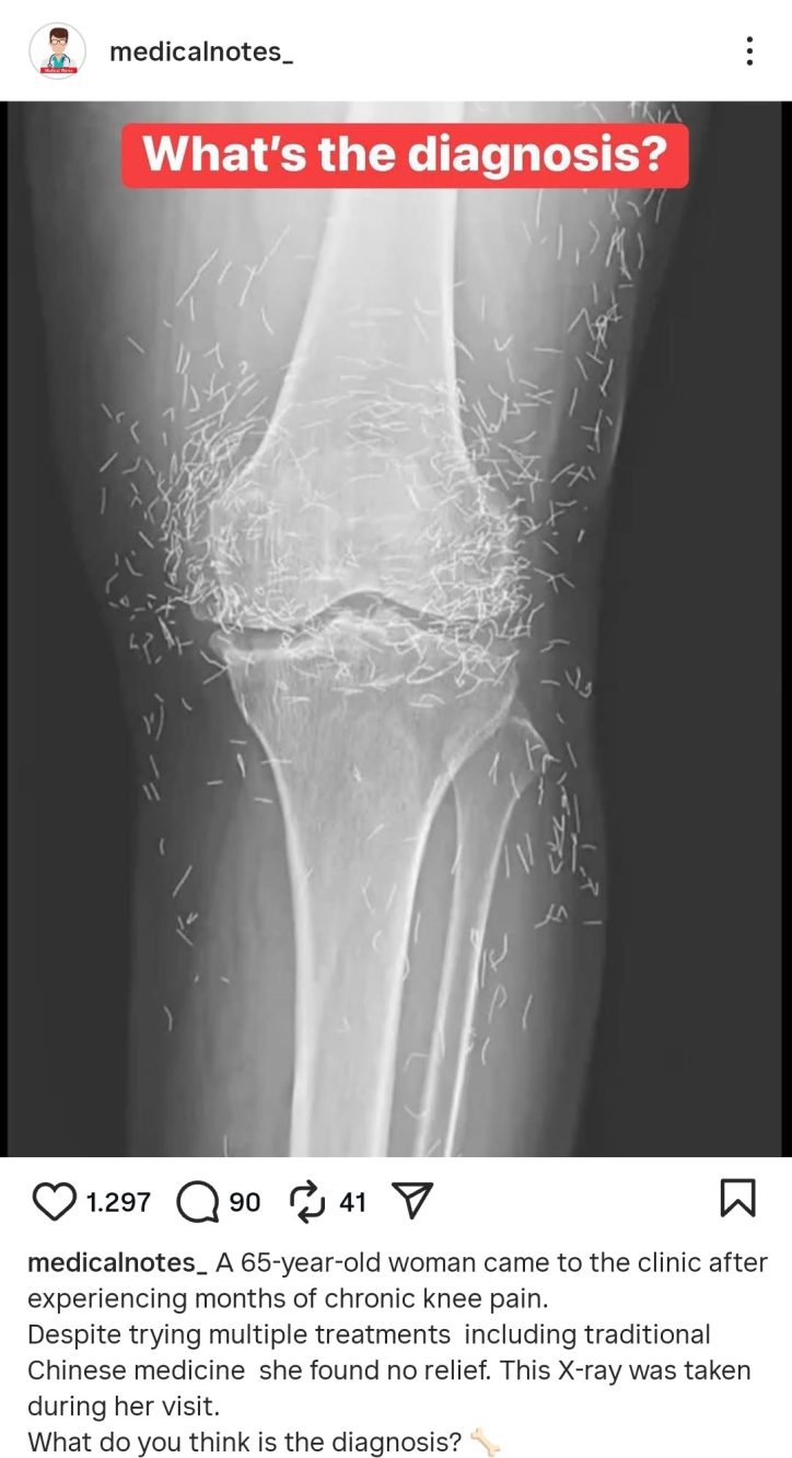 Anche una community social appassionata di medicina ha discusso il curioso caso dell'oro nelle ginocchia