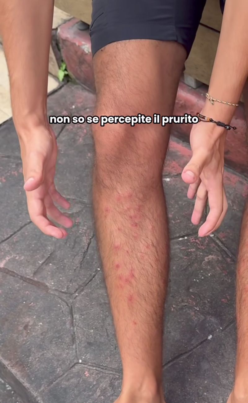 La follicolite sofferta dal turista italiano in Thailandia a seguito di un massaggio