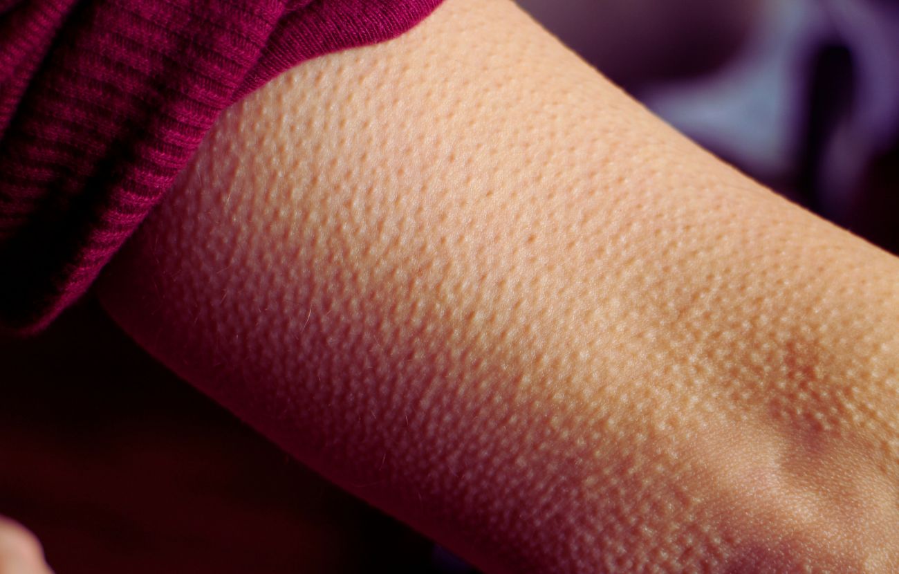 La cosiddetta pelle d'oca, in inglese "goosebumps"