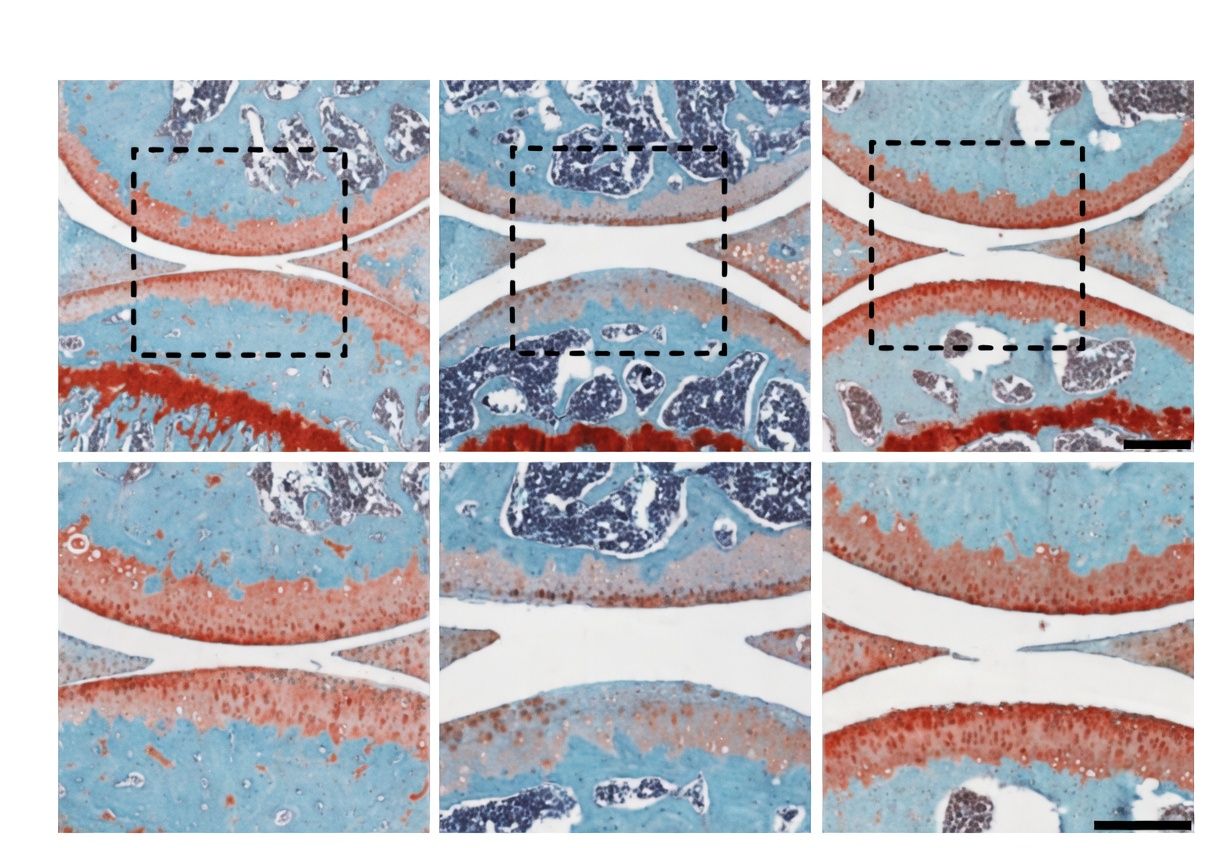 Osteoarthritis 15pgdh