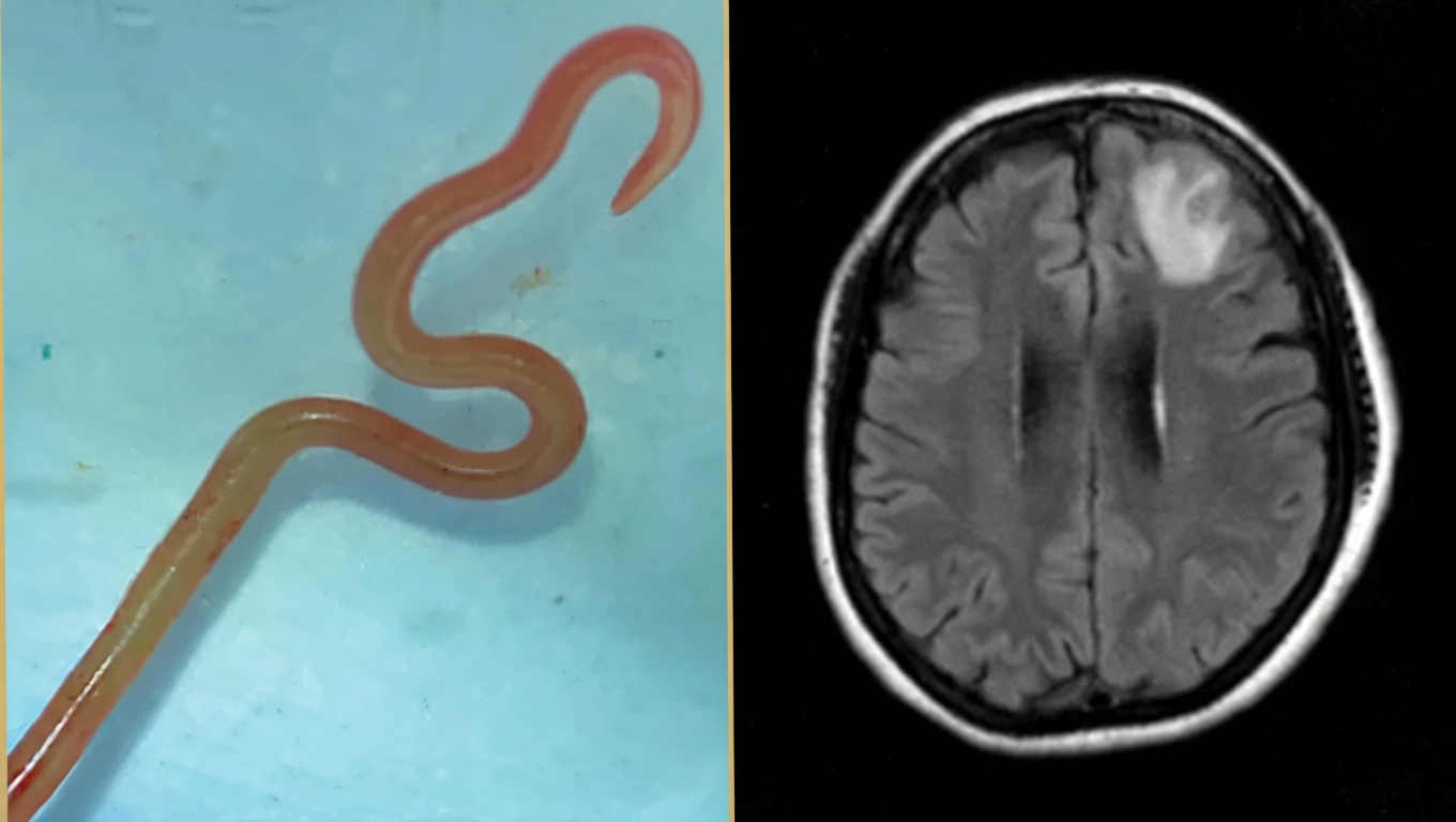 Parassita Cervello Umano