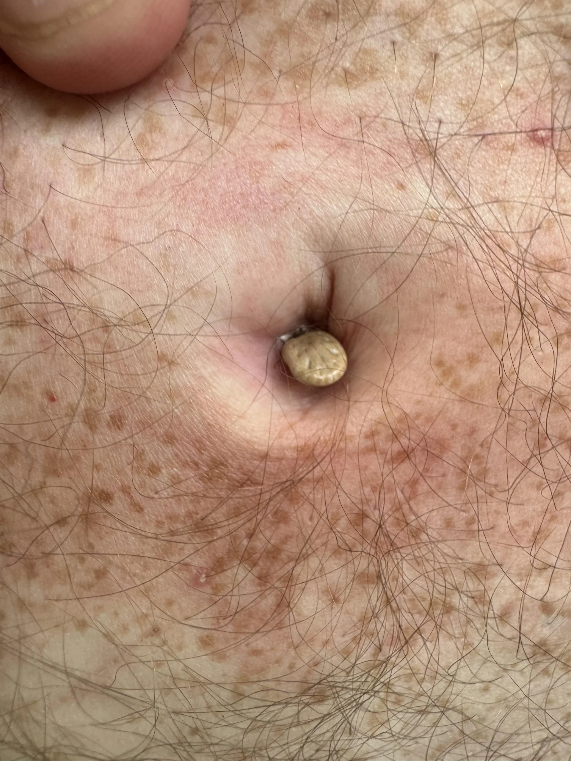 Zecca sulla pelle: come riconoscerla, rimuoverla in sicurezza e quando preoccuparsi