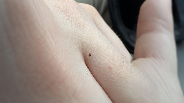 Zecca sulla pelle non attaccata: hai una finestra di tempo prima del morso, ecco come usarla